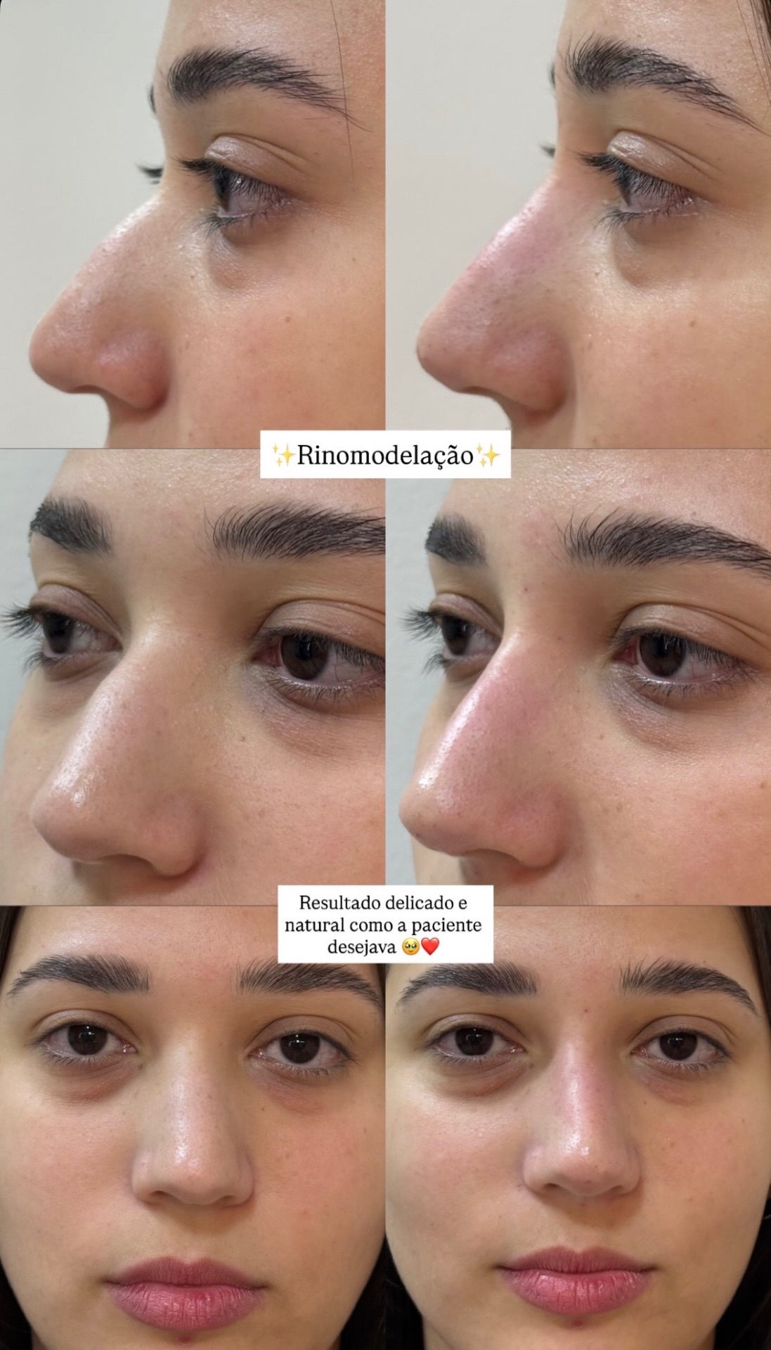 Resultado real de rinomodelação com resultado delicado e natural
